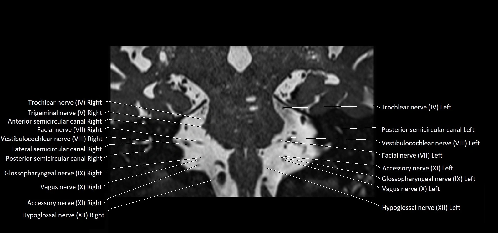Cranial nerve cross sectional anatomy coronal 3T MRI image 44.webp